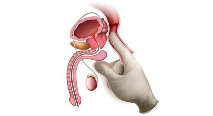 Diagram of prostate location